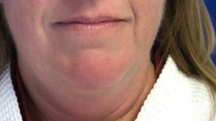 Neck Lipo lift Dr Suzman Pre
